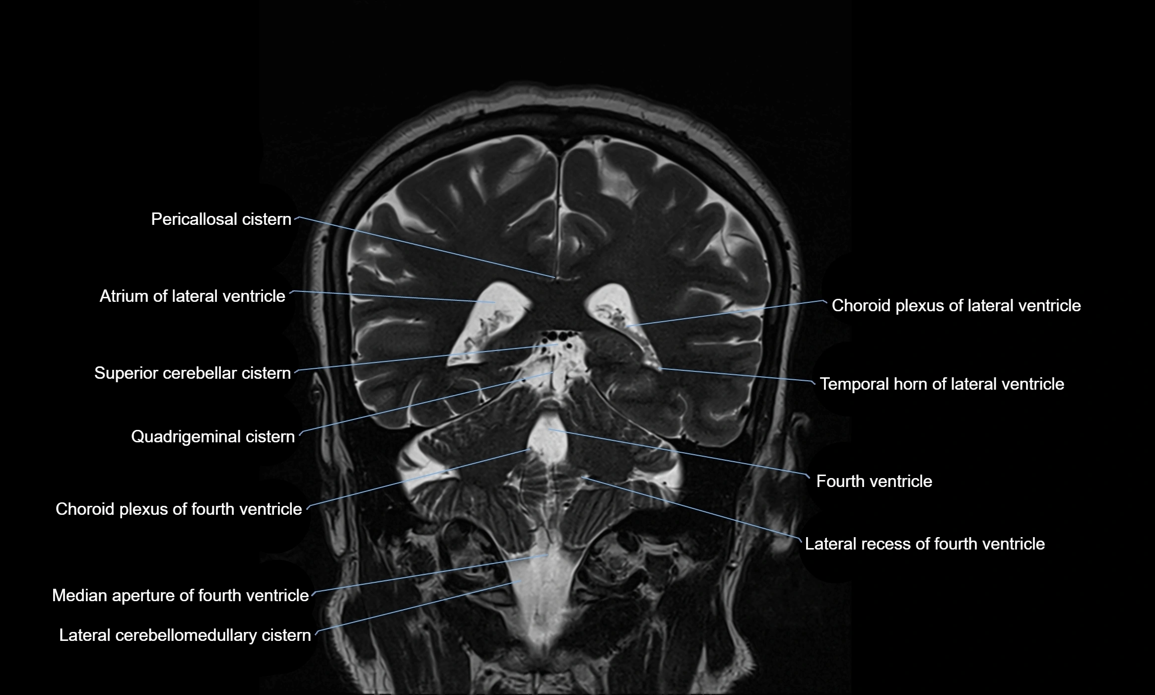 Brain cisterns  and ventricles coronal anatomy 3T MRI image-img-00001-00040.webp